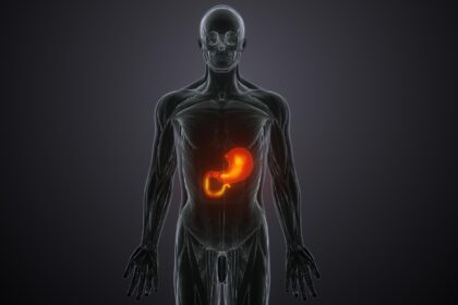 Symptoms of Steatosis: such as fatigue, abdominal discomfort, yellowing skin (jaundice), and liver enlargement