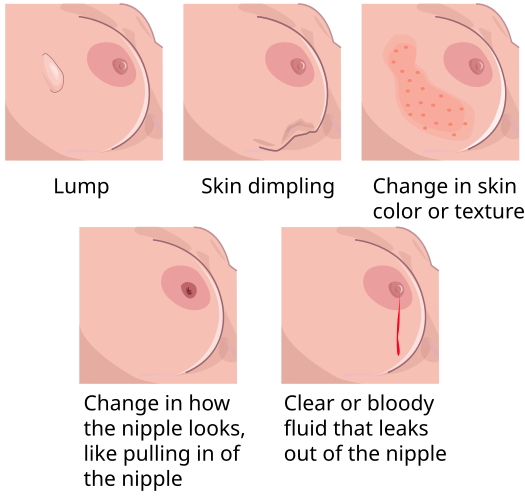 Do Parasites Cause Breast Cancer